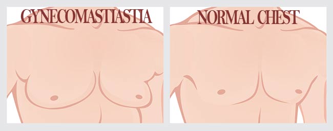 Identify Gynecomastia
